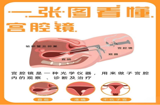 2026081515472305.png 宫腔镜.png